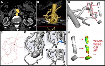 Patient-specific modeling of hemodynamic characteristics associated with the formation of visceral artery aneurysms at uncommon locations